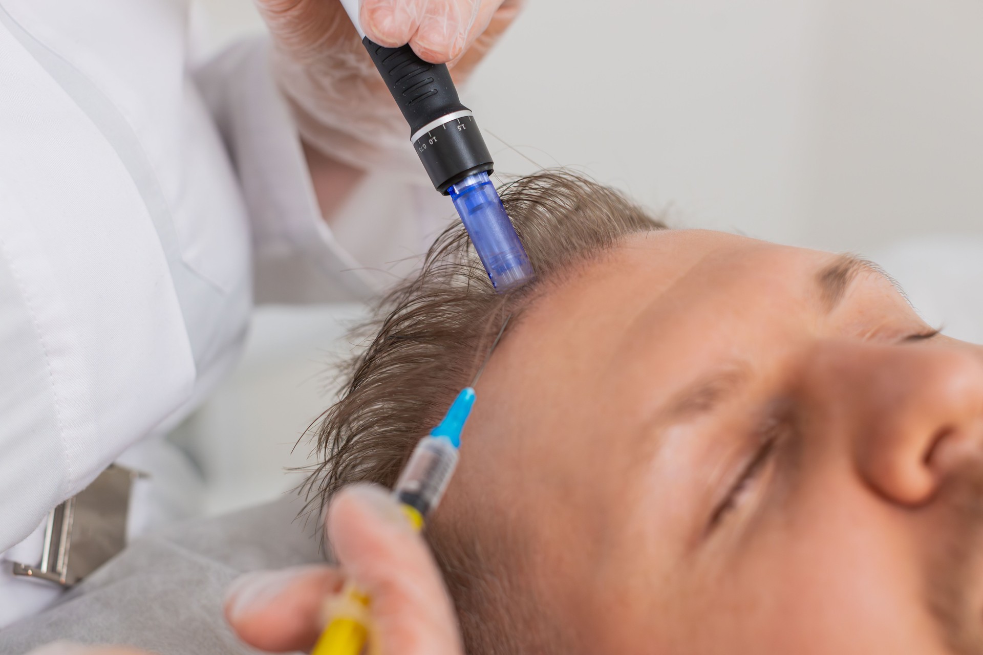 Trichologist doing man improve hair growth procedure, dermapen microneedling, vitamin injections